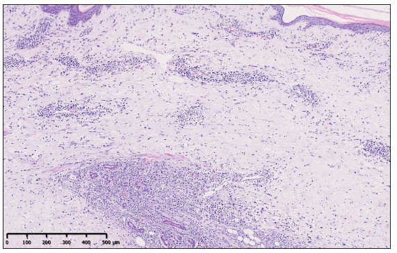 Histopathological examination showed a dermal and subcutaneous infiltration of atypical lymphoid cells, with angiocentricity. (Haematoxylin and eosin, 100x)